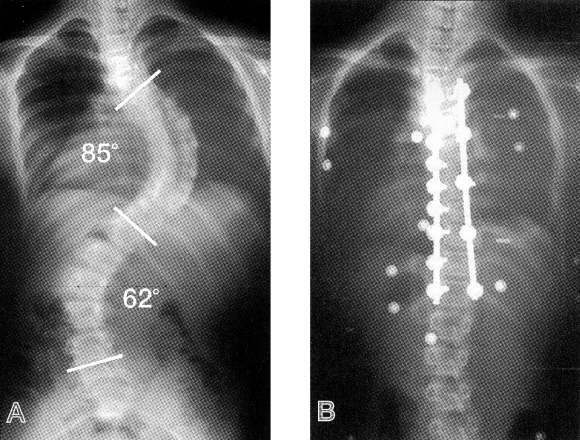 좌우로 굽어 전형적인 이중 만곡(왼쪽) 상태를 보이는 11세 측만증 환자의 수술 후 척추 모습.