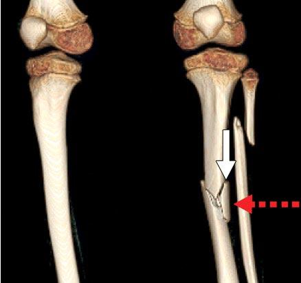 교통사고 등을 당한 보행자 뼈에 나타난 메세레르 골절의 모양. 점선 화살표는 충돌방향, 흰 화살표는 부러진 뼈조각의 모습이다. 출처 Radiographics.rsna.org