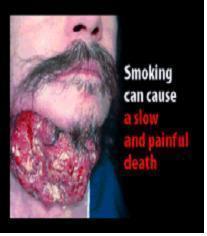 영국의 담뱃갑 흡연 경고 그림.
