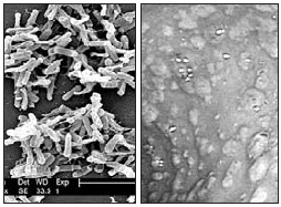 항생제에 의해 발생한 대장염을 대장내시경으로 관찰한 모습(왼쪽)과 문제의 원인인 CDI균을 현미경으로 잡은 사진.
