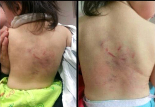 피해 유아의 부모가 피멍이 든 딸의 등을 촬영해 인터넷 등에 올린 사진. 연합뉴스
