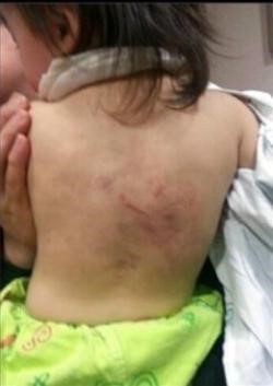 부산 수영구 공립 어린이집에서 보육교사에게 폭행을 당한 이모(1)양이 등에 피멍이 든 모습. 아이의 부모가 스마트폰으로 촬영해 경찰에 제출했다. 부산 남부경찰서 제공