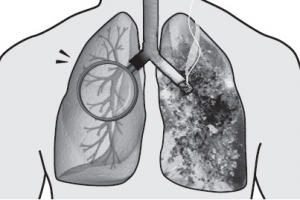 폐암 조기진단 55세부터 저선량CT가 효과적