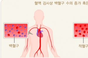 “짧은 시간안에 죽을 수도…” 故박용식 사망 원인 ‘패혈증’은?