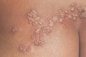 ‘대상포진’ 더운 여름 환자 급증 이유는…