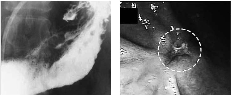 환자의 위를 위장 조영술(왼쪽)과 위 내시경(오른쪽)으로 검사한 사진. 조영술로는 발견되지 않았던 암 소견이 내시경에서는 확연히 나타남을 알 수 있다.