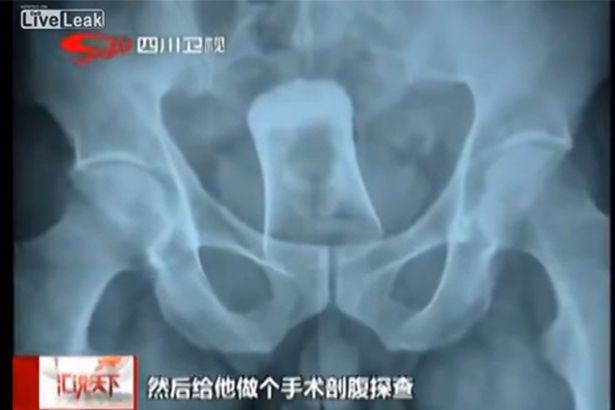 16일(현지시간) 중국 쓰촨성 더양에 사는 류모씨의 몸에 양주잔이 들어있는 모습을 찍은 엑스레이 사진 영국 미러 캡처