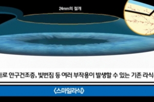 라식·라섹수술 시 각막손상률 줄이면 부작용 위험 줄어든다