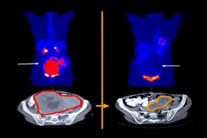 진단 어려워 치료 늦은 기스트, 이제 암세포만 콕 찍어 공략한다