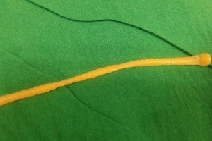 항문서 나온 3m 기생충…충격적 생김새 보니