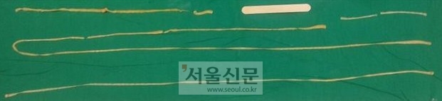 3.5m 길이 기생충. 한양대병원 제공