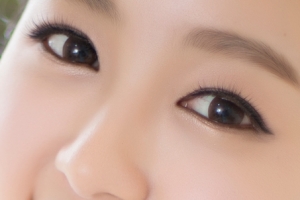 눈성형수술 후, 부기 생기는 이유와 빨리 뺄 수 있는 방법은?