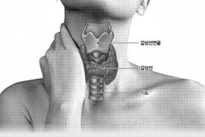 “평생 후유증” vs “불안해” 갑상선암 수술 할까 말까