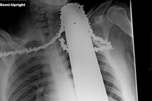 가슴에서 목까지 전기톱 박힌 남성, 기적적으로 생존