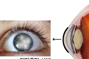 뿌옇게 보이는 라식, 라섹의 부작용 각막혼탁, 미리 예방하자!