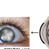 뿌옇게 보이는 라식, 라섹의 부작용 각막혼탁, 미리 예방하자!