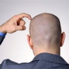 탈모 환자 20~30대가 43.9%로 절반 육박