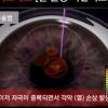 아마리스레드 라식, 각막손상 어떻게 낮췄나?