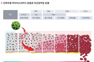 2030 여성 자궁 건강 적신호…자궁경부암 정기검진 미루면 안돼