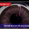 아마리스레드 라식·라섹, 회복 속도 높이고 부작용 가능성 낮춰