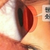 ‘PD수첩’ 라식 라섹 부작용 “11년 째 언제 실명할지 몰라” 경악