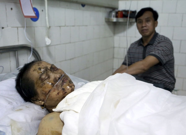 22일(현지시간) 폭죽공장 폭발사고로 다친 남성이 병원에 누워 있다. 오후 3시쯤 중국 후난성 리링시에 있는 한 폭죽공장에서 폭발사고가 나 최소 12명이 숨지고 수십명이 부상했다고 당국이 전했다. AP/뉴시스