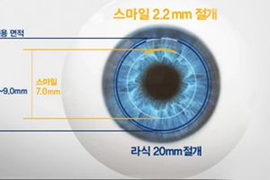 각막손상 최소화한 ‘3D 스마일라식’, 안구건조증 줄여