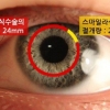 스마일라식 수술, 각막절개 최소로 라식, 라섹 부작용 예방한다