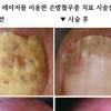 손발톱무좀 레이저치료 임상 성과 국내 첫 발표