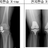 ‘망가진 무릎’, 고장난 곳만 인공관절 대체하면 ‘끝’
