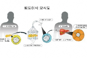 국내 처음으로 타인 췌도 이식해 당뇨병 완치 성공