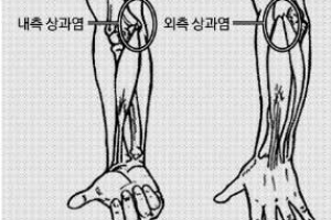 [최병규 전문기자의 골프는 과학이다] 팔꿈치 통증 ‘내측 상과염’ 예방법