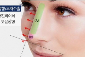 코성형·코재수술 인공보형물 대신 내 피부 이용한다