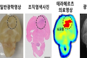 전자파 활용해 뇌종양 진단 정확도 높인다