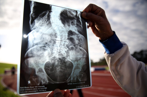 100세 마라톤 참가자 엑스레이  뉴질랜드 오클랜드의 트러스츠아레나에서 24일(현지시간) 열린 2017 월드 마스터스 게임에서 100세 이상자 100m 달리기 종목에 참가한 인도의 만 카우르 씨(101)의 엑스레이를 관계자가 들어보이고 있다.<br>2017.04.25 사진=AFP연합뉴스