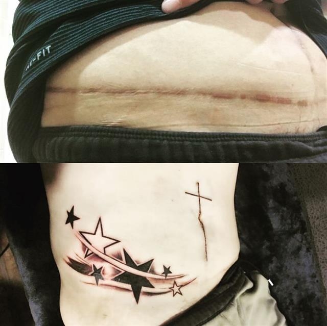 수술 자국에 문신을 덧입히는 ‘커버업 타투’가 유행이다. 복부의 수술 자국 위에 별과 십자가 모양의 문신을 새긴 모습. 한국타투협회 제공
