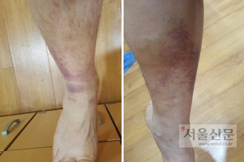 전북대병원 폭행 피해자 A씨가 제공한 사진. A씨는 “가슴을 주먹으로 때리거나 다리를 걷아차는 폭행이 이어졌지만 아무도 관심을 보이지 않았다”고 밝혔다. A씨 제공