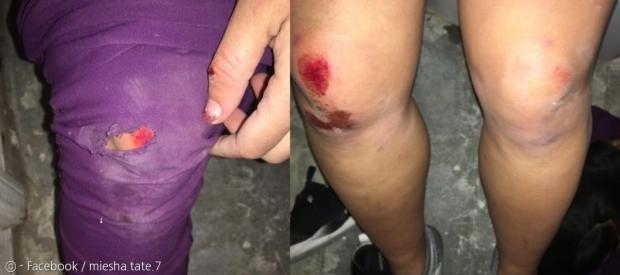 미샤 테이트가 반려견을 구하는 과정에서 다리를 다쳤다.