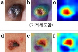 피부암 찾는 AI  전문의 능가하네