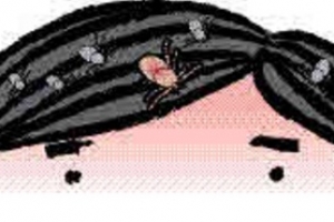 골 아픈 ‘머릿니’ 전쟁···초등생 왕따 주의보