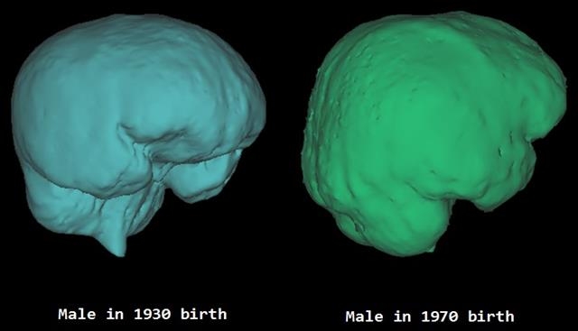 1930년대생 두개골(왼쪽)과 1970년대생 두개골(오른쪽)