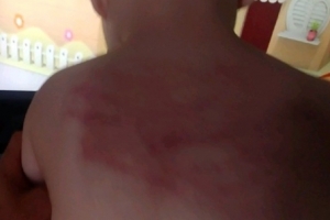 어린이집서 탈북민 아이 학대 정황…“등에 맞은 자국 있어”