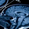 뇌전증 동반하는 소아 뇌종양 원인 규명