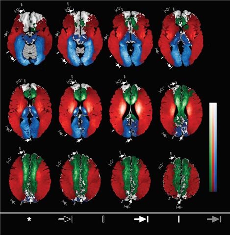 각각의 대뇌혈관이 혈류공급을 담당하는 뇌의 영역을 색으로 구분한 뇌혈류지도(빨간색 &#8211; 중대뇌동맥 / 녹색 &#8211; 전대뇌동맥 / 파란색 &#8211; 후대뇌동맥) 한국표준연구원 제공 