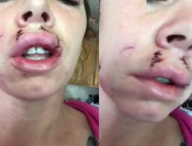핏불로부터 얼굴을 물린 한 여성의 끔찍스런 모습(유튜브 영상 캡처)