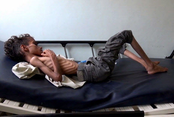 참혹한 예멘 내전… 뼈만 남은 소년