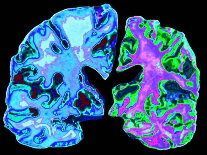 정상적인 70대 노인의 뇌 사진(왼쪽), 알츠하이머 치매에 걸린 70대 노인의 뇌(오른쪽) 네이처 제공