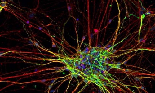 정상인보다 빠르게 자라는 자폐증 환자의 뇌 신경세포  미국 솔크 연구소