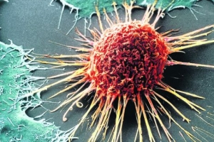 암세포가 커지고 전이되는 원인은 지방 때문