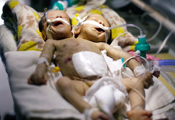 약 열흘 전 예멘에서 태어난 샴쌍둥이가 6일(현지시간) 예멘 수도 사나의 타와라 병원의 인큐베이터에 누워 있다. 로이터 사나 연합뉴스 